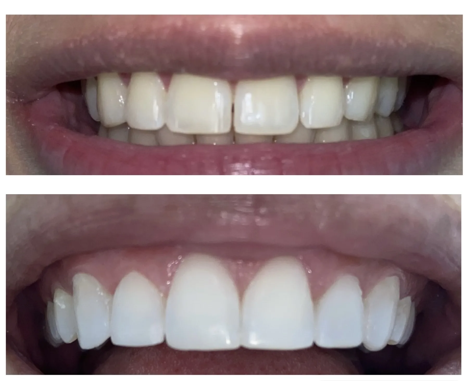 Resultado blanqueamiento dental LED — sonrisa perfecta Cali